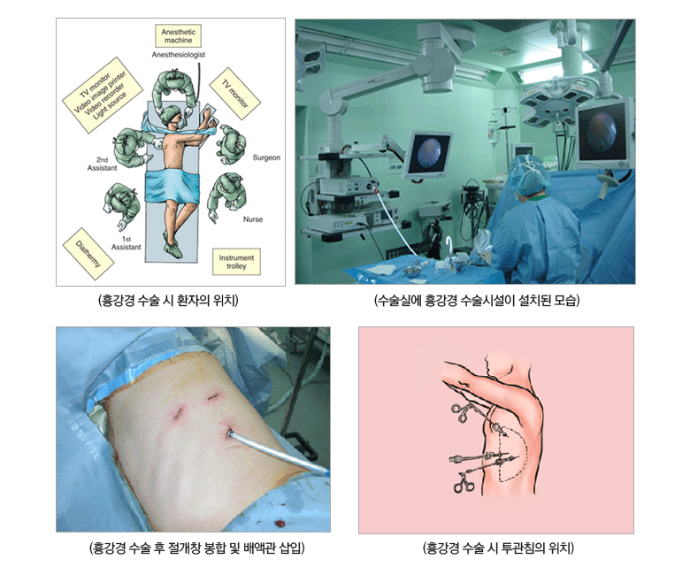 흉강경 수술 시 환자의 위치 / 수술실에 흉강경 수술시설이 설치된 모습 / 흉강경 수술 후 절개창 봉합 및 배액관 삽입 / 흉강경 수술 시 투관침의 위치