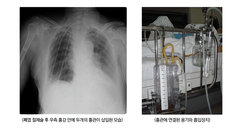 폐엽 절제술 후 우측 흉강 안에 두개의 흉관이 삽입된 모습 / 흉관에 연결된 용기와 흡입 장치